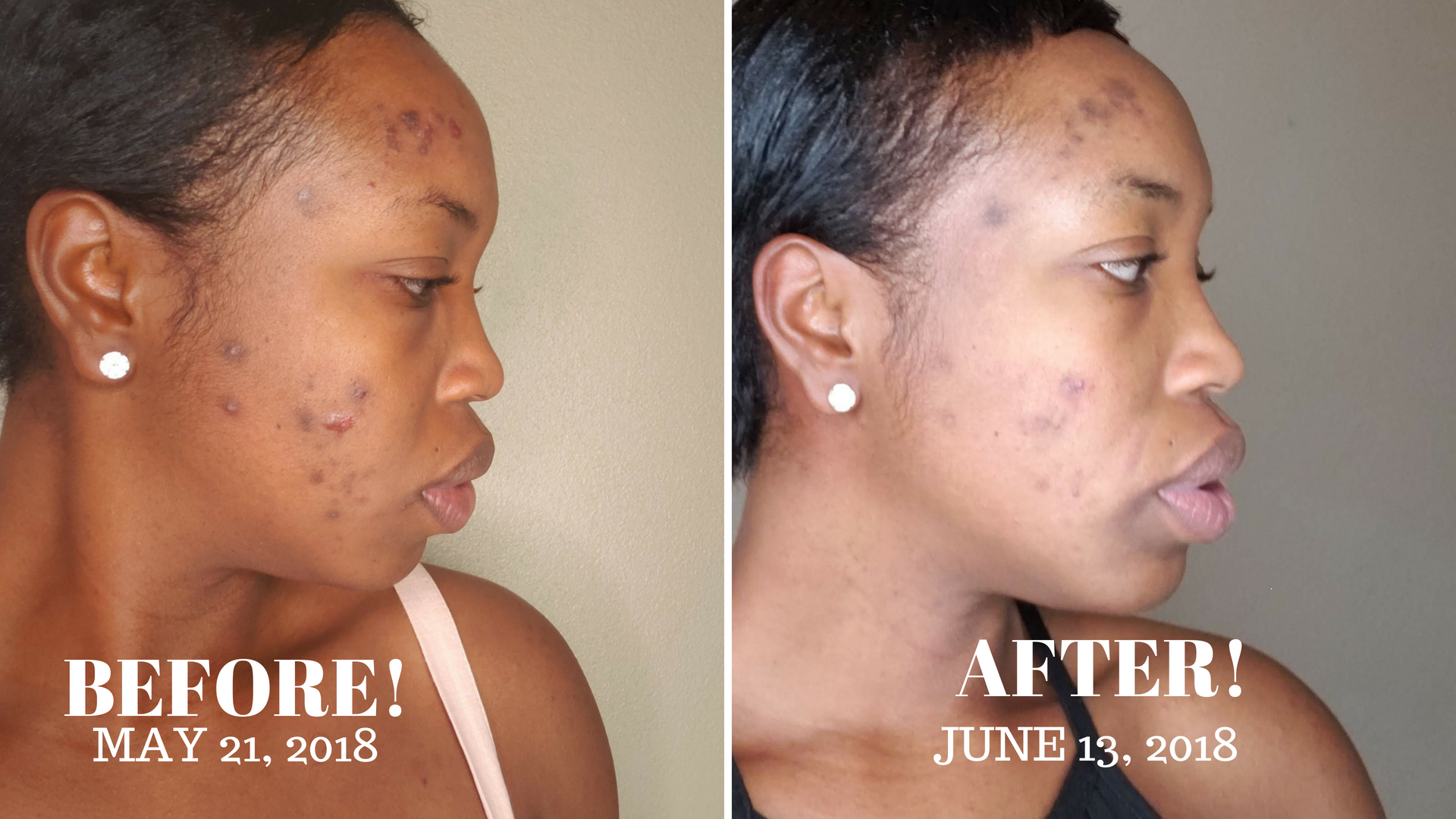 Chemical Peel Before During and After image