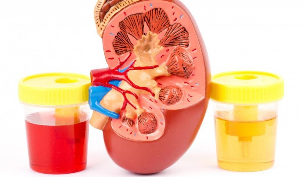 sangre en la orina hematuria e1451740204447