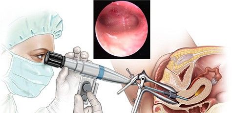 OG04 Hysteroscopy WM