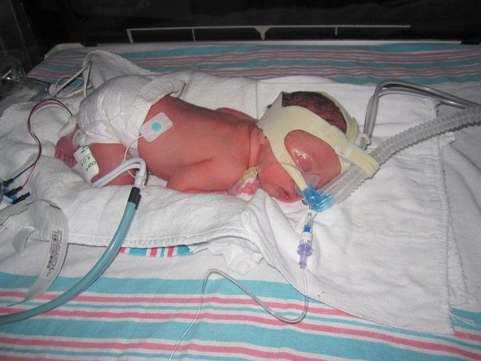 Respiratory Distress Syndrome In Newborns