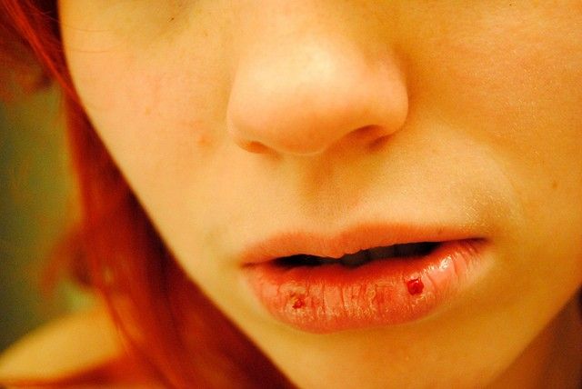 chapped lip tips