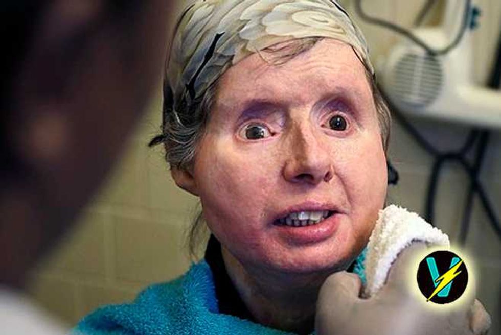 Chimp Attack Victim Charla Nash’s Body Rejecting Face Transplant