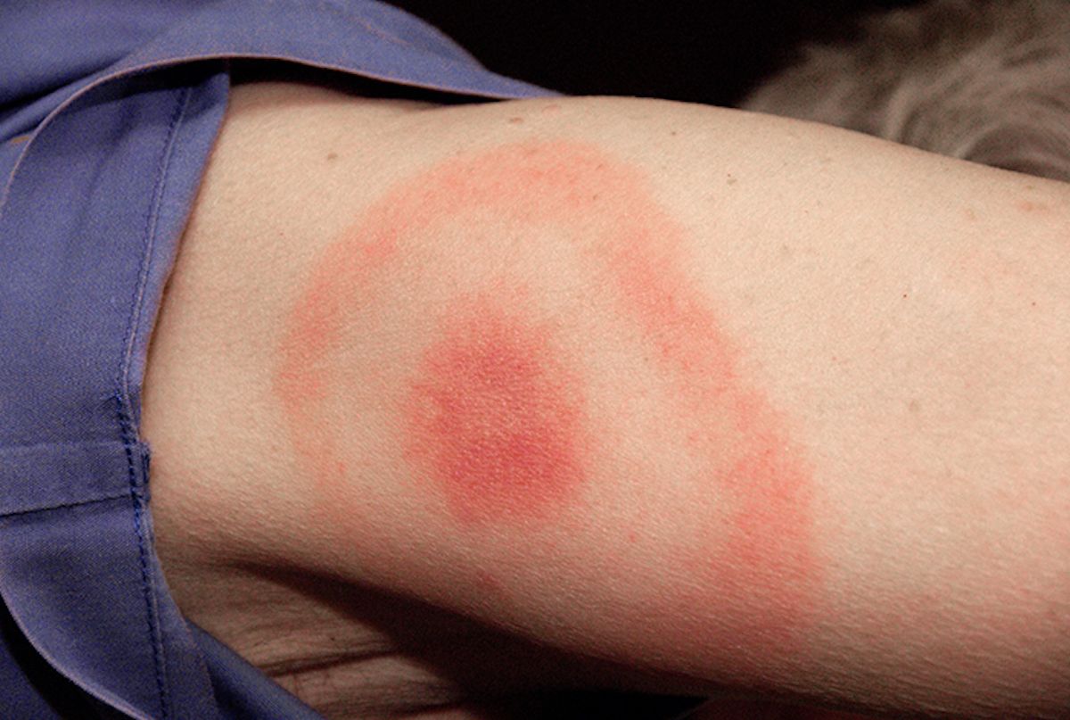 What It's Like Living With Lyme Disease