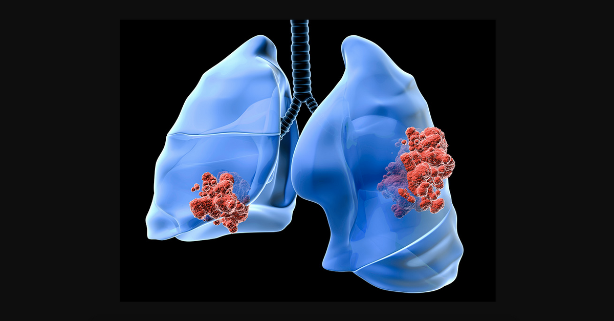 In and Outs Of Lung Cancer