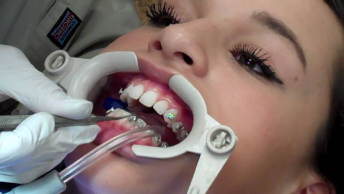 20 Things That Happen When You Get Your Braces Taken Off