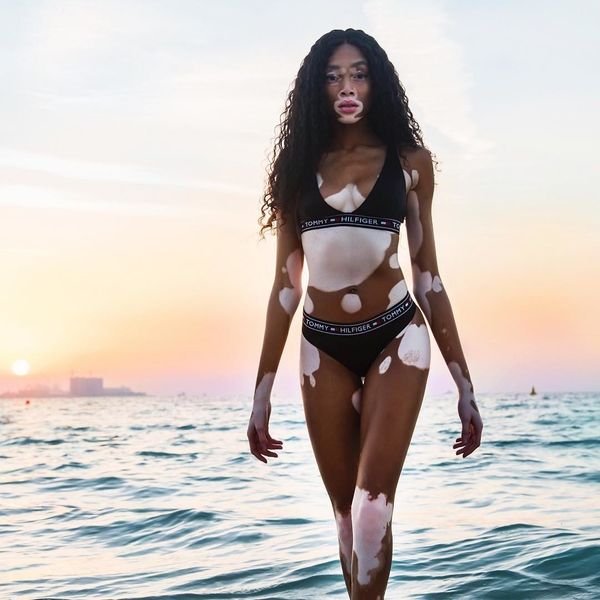 Winnie Harlow to the Media: 'Do You See Me Suffering?'