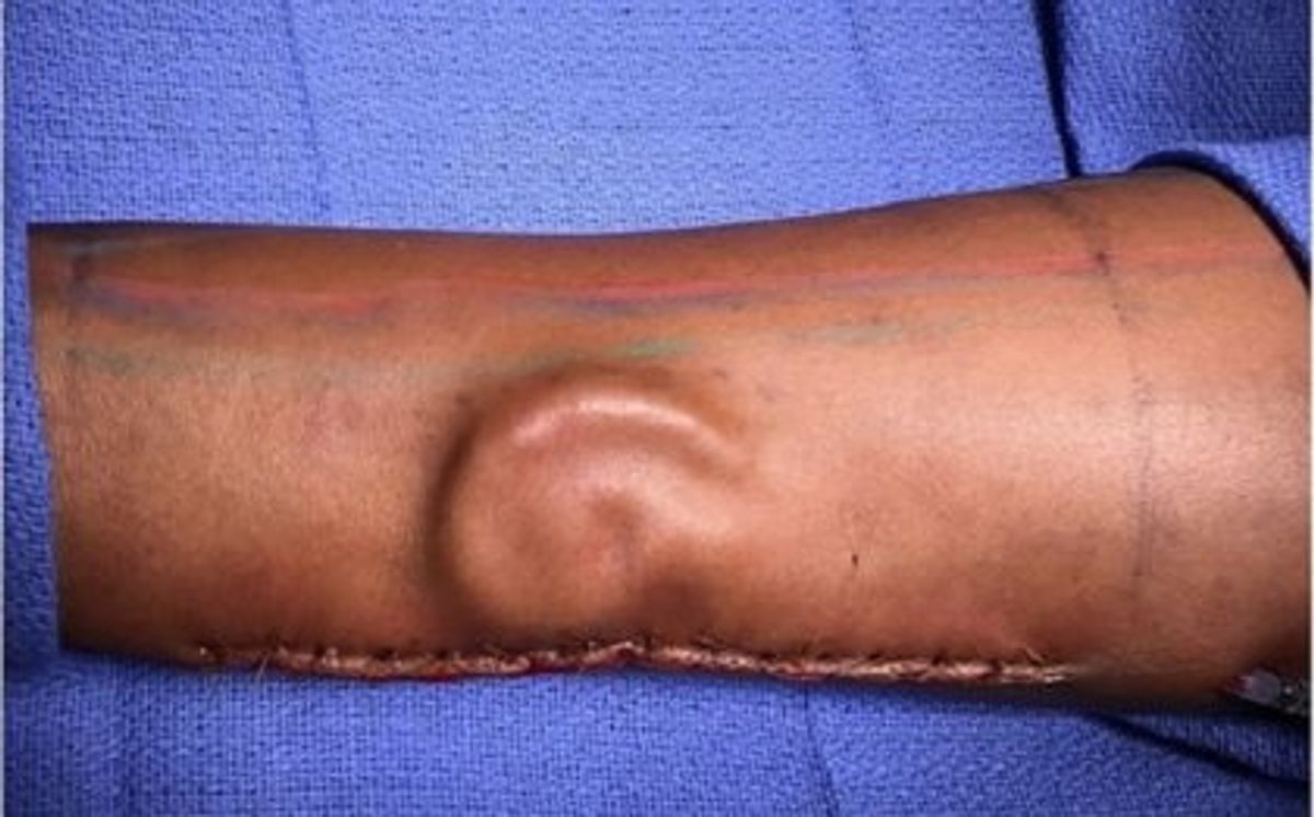 This Ear Transplant Was Made From Rib Cartilage And Grown In The Patient's Arm. You Know, Normal Stuff.