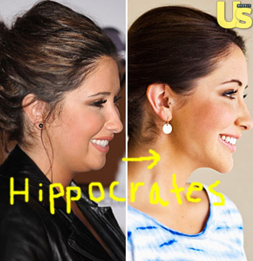 Bristol Palin's Facelift Was 'Necessary For Medical Reasons'