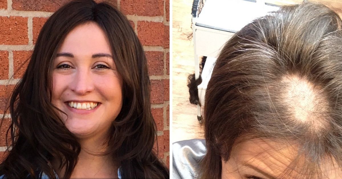 After Car Crash, Woman Starts Compulsively Yanking Out Hair In Fistfuls