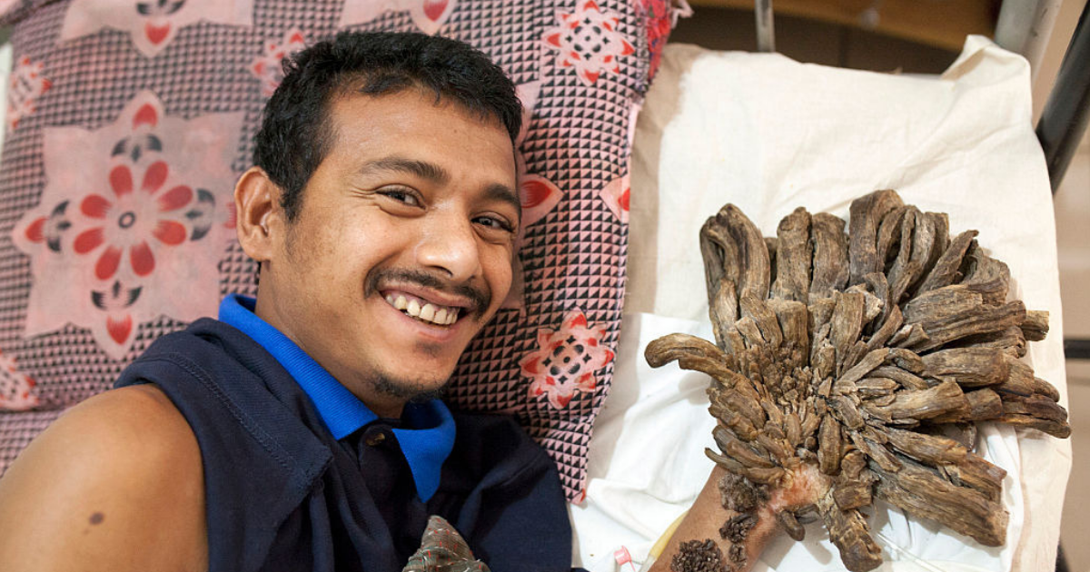 Man Suffering from Rare “Tree Man” Syndrome To Undergo More Surgeries After Growths Return