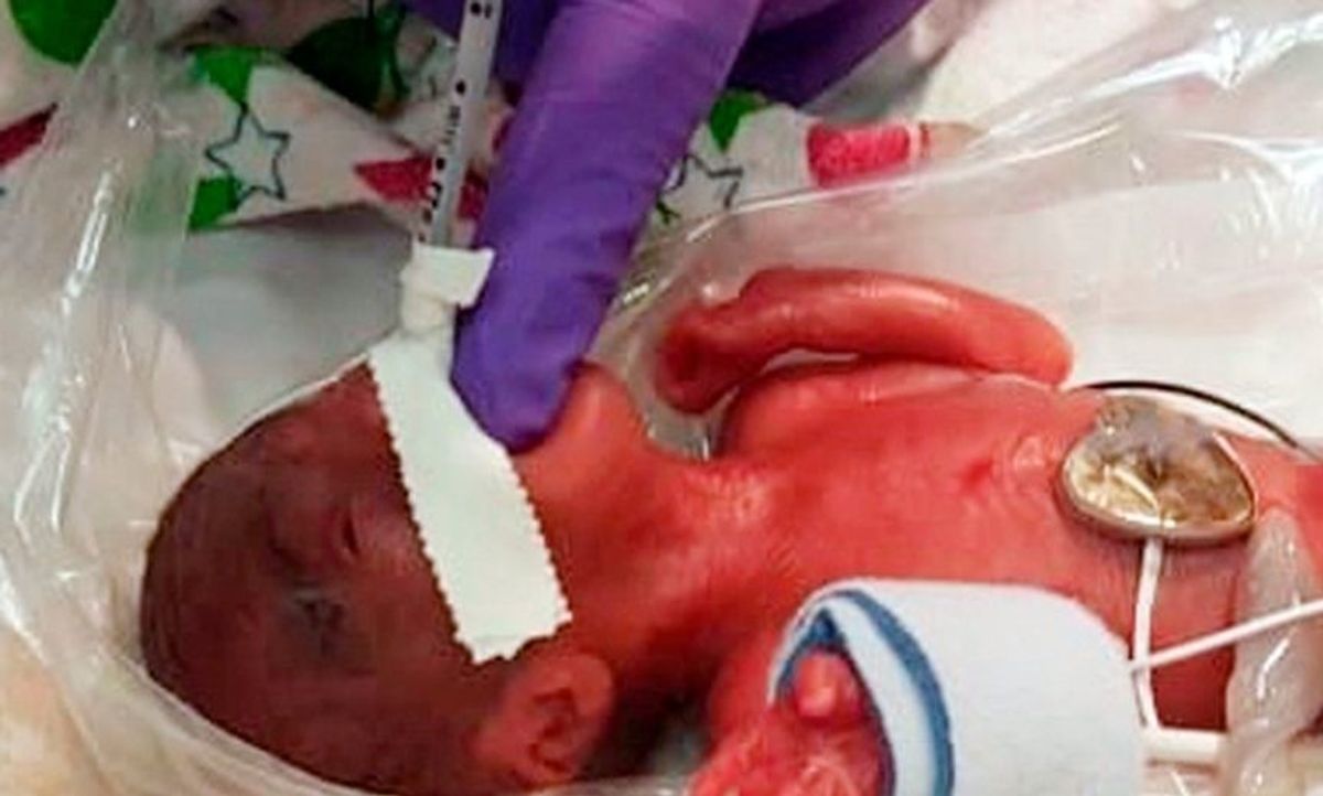 Girl Believed To Be The Tiniest Baby Ever To Survive Only Weighed As Much As An Apple At Birth
