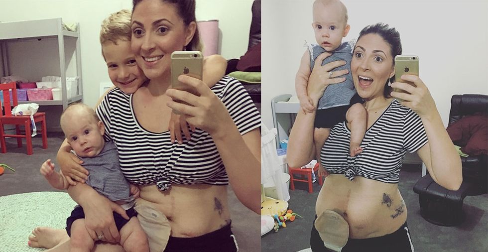 This mom's empowering selfies show off life with an invisible illness.