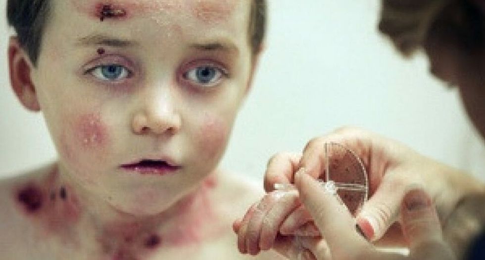 Doctors Saved a Young Boy By Genetically Modifying His Skin and His Recovery Is Incredible