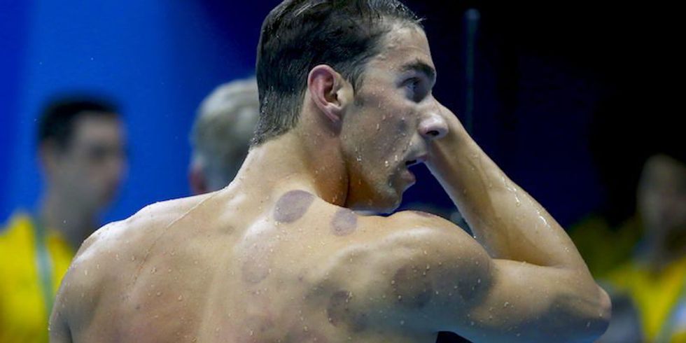 Phelps Shows His Spots: The Ancient Medical Practice Many Olympians Are Embracing