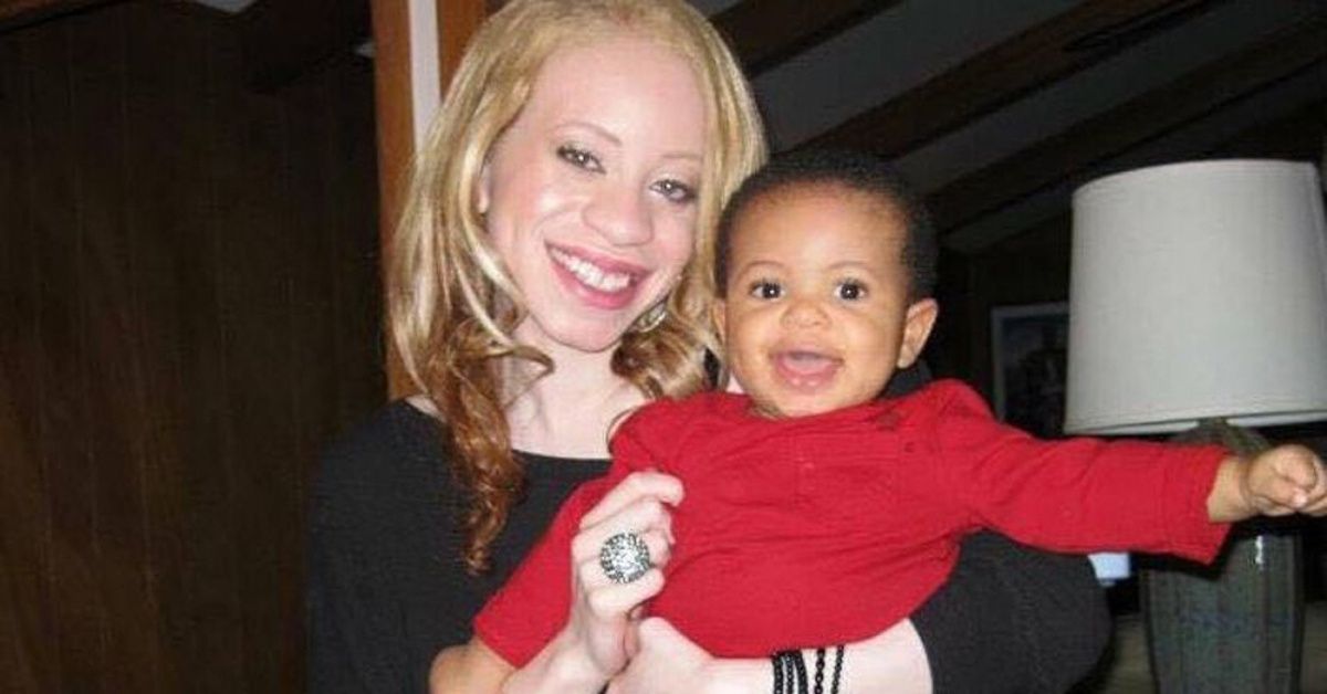 African American Woman Who Faced Merciless Bullying For Her 'Ghostly White' Skin Became 'The First Albino Influencer'