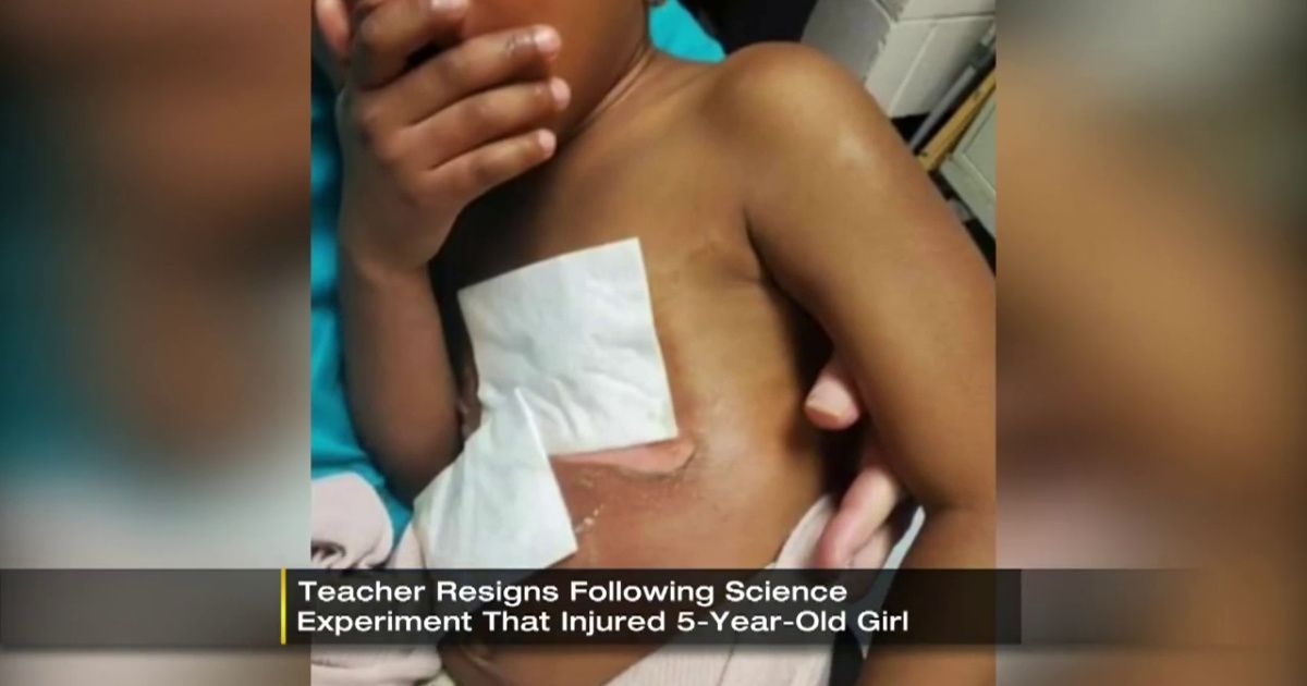 Pittsburgh Kindergarten Teacher Resigns After 5-Year-Old Girl Ends Up With Severe Burns From Class Science Experiment