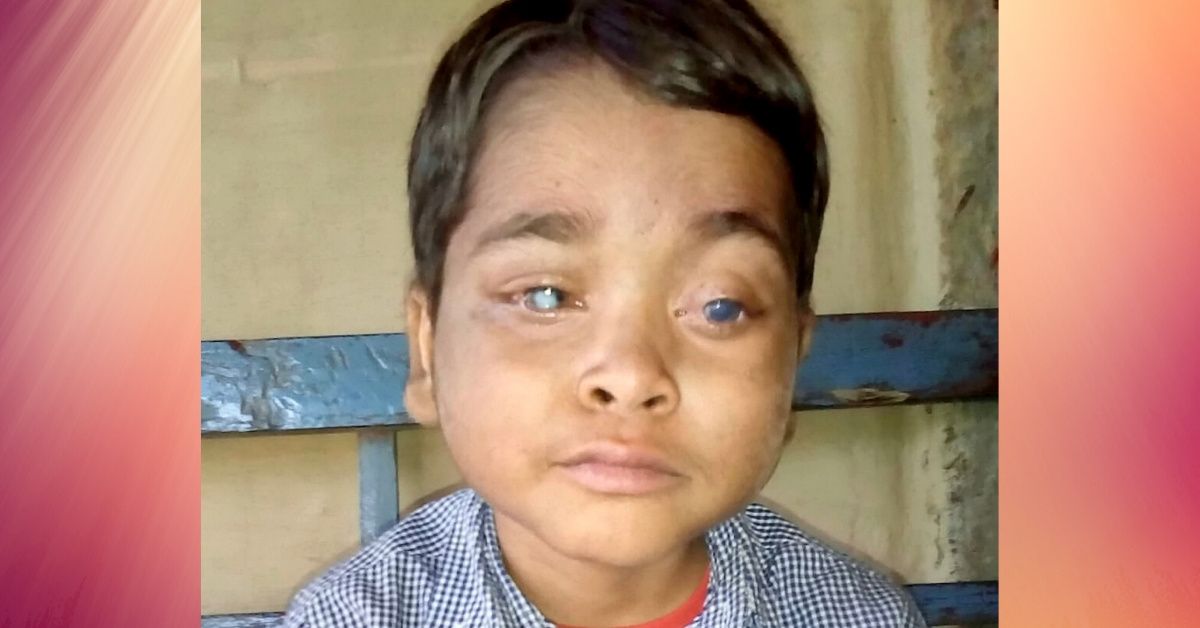 Boy Who Went Blind After His Leukemia Caused His Eyes To Pop Out Gets His Vision Restored Thanks To Kindhearted Stranger