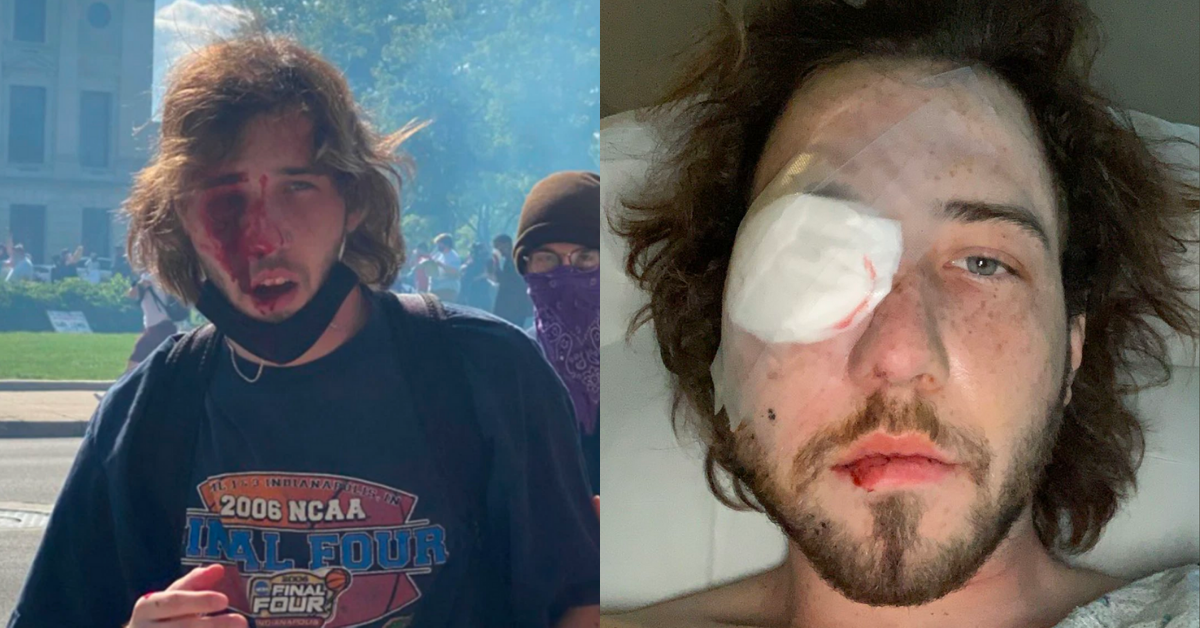 Indiana Protester Loses An Eye After Being Shot In The Face By Police With A Tear Gas Canister