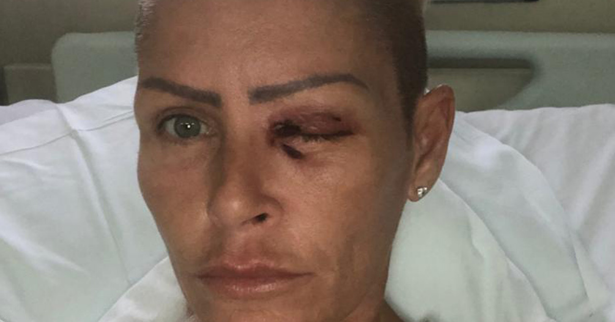 Mom Explains How She Almost Lost An Eye After A Tiny Cut Sparked A Dangerous Eye Infection