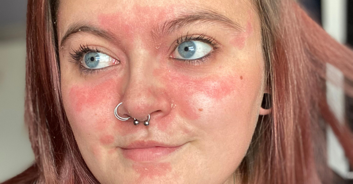Woman With One Of The 'Worst Cases' Of Psoriasis Her Doctors Had Ever Seen Embraces Condition