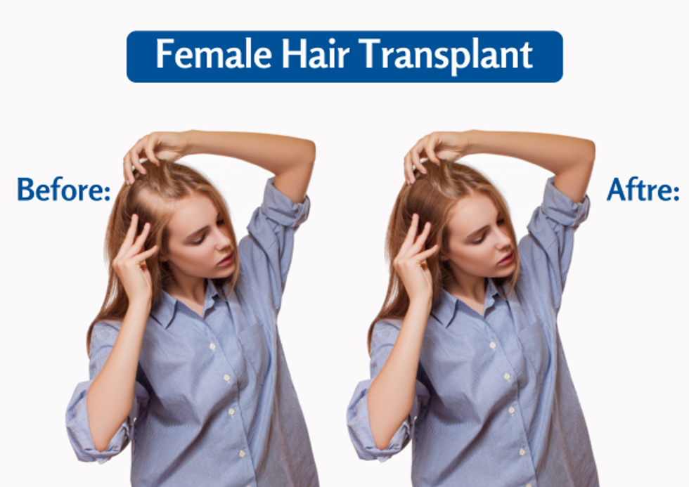 Female Hair transplant Treatment-You must know in 2021
