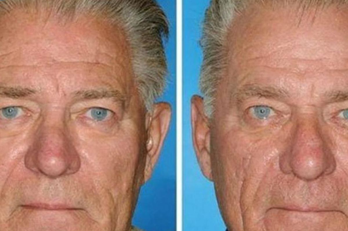 smokers versus non-smokers, smokers skin, twins