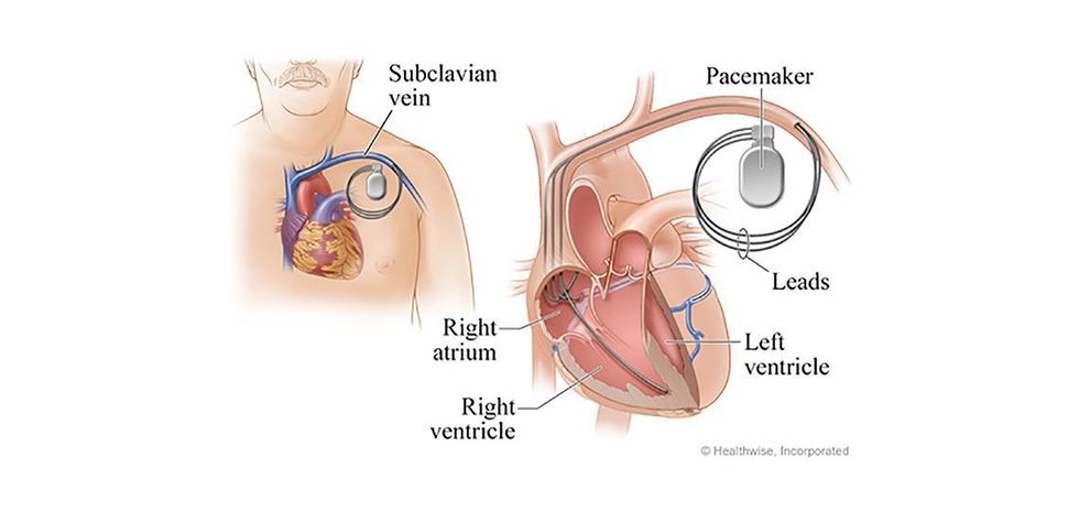 how-does-a-pacemaker-make-you-feel-better