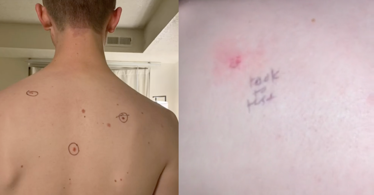 Dermatologist Writes Notes Next To Guy's Moles After His Wife Circled Them Out Of Concern