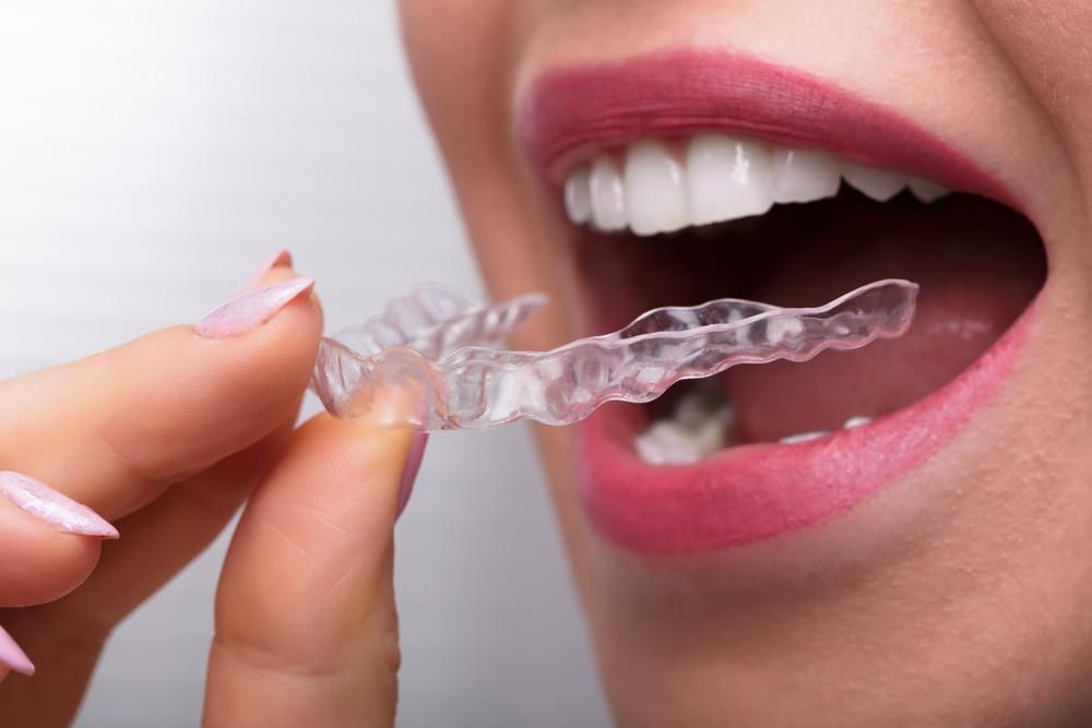 Accuracy Of Invisible Aligners
