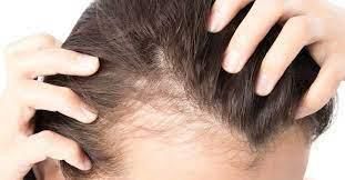 All about Male pattern baldness before choosing your treatment