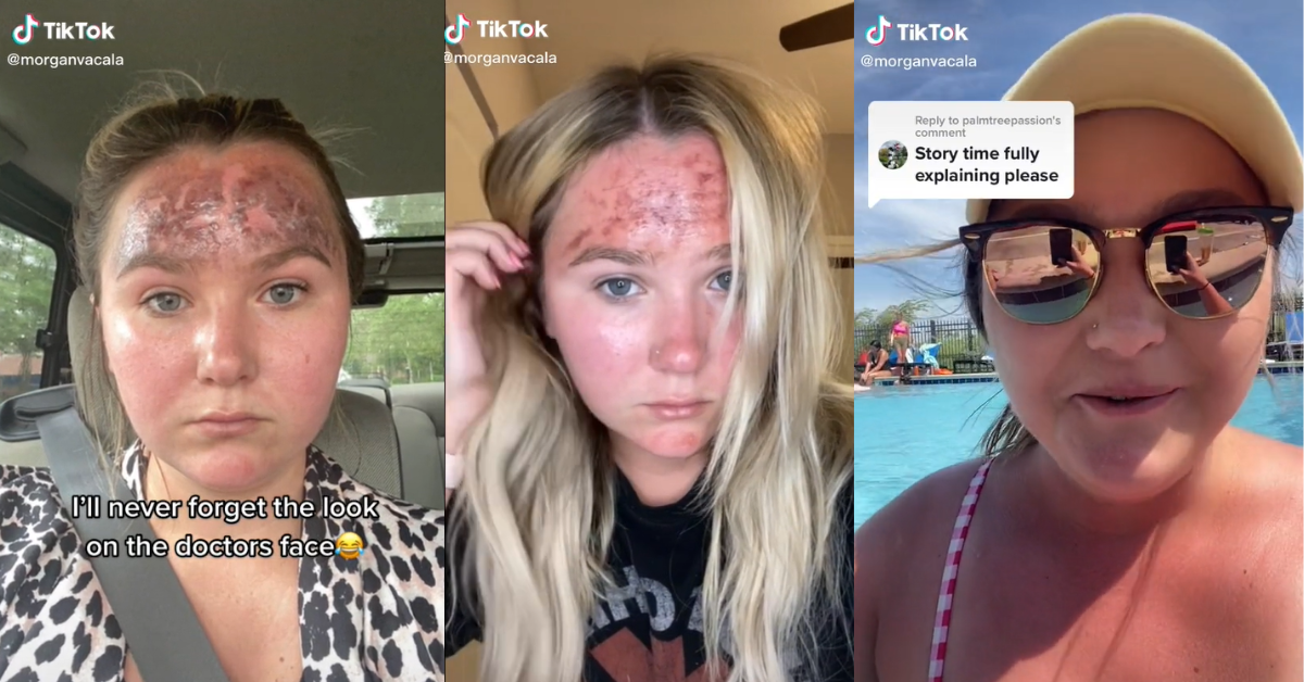 sunscreen after burn