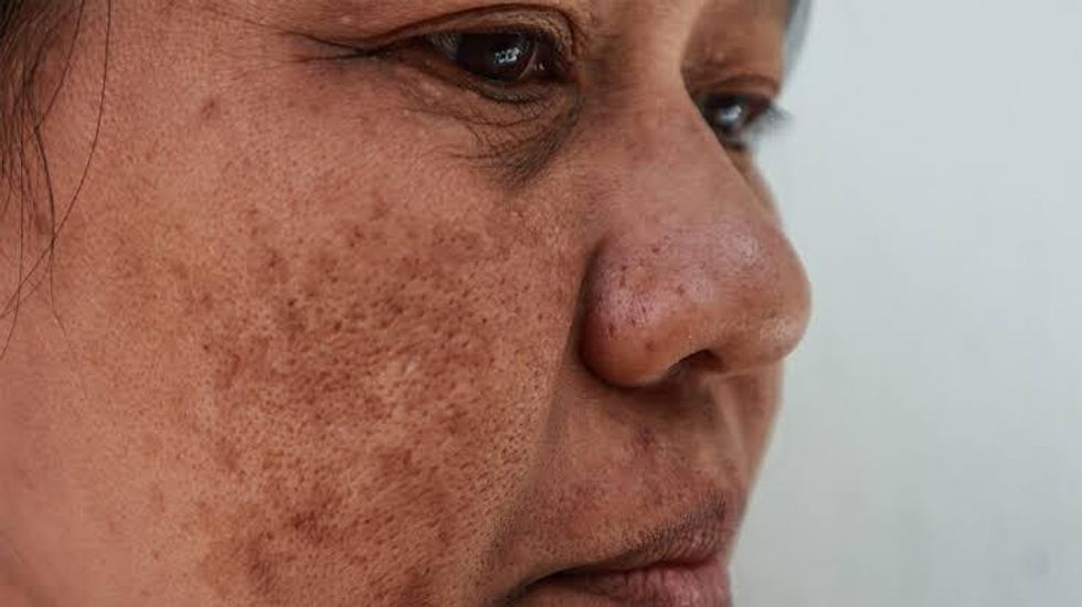 What is melasma and what are its causes, and the way to treat it?