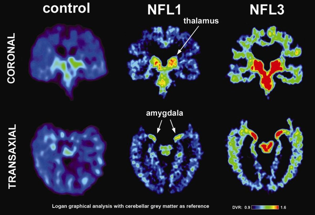 what-to-know-about-cte-brain-disorder