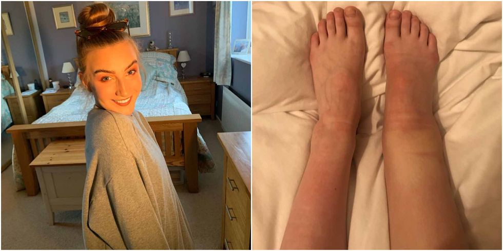 Student With Dreams Of Dancing Professionally Requires Expensive Surgery After Leg Swells By 30 Percent