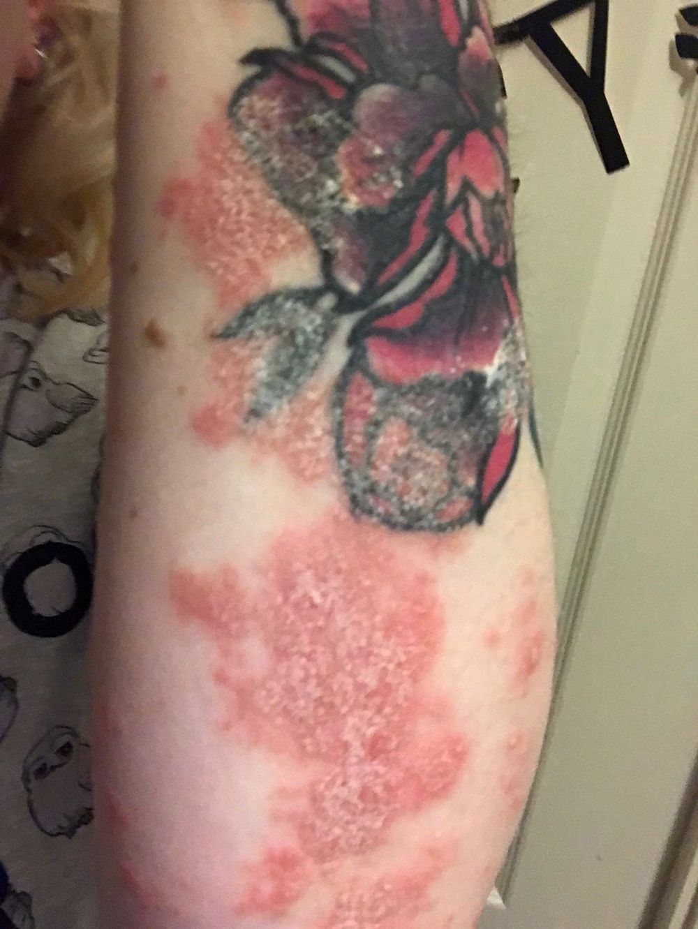 Woman Who Thought She Had Dandruff Diagnosed With Severe Psoriasis That Turned Her Tattoo Into A Blurry Mess - Comic Sands