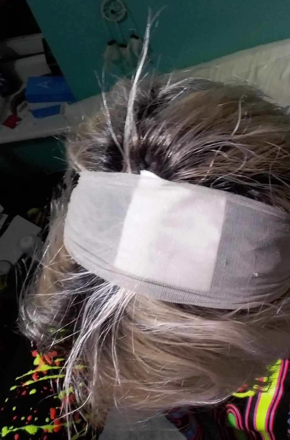 Woman Left With Severe Chemical Burns On Her Scalp After Bleaching Her