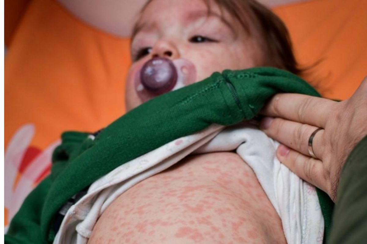 GOP Legislators Undermine Public Health As Measles Spreads Across 15 States