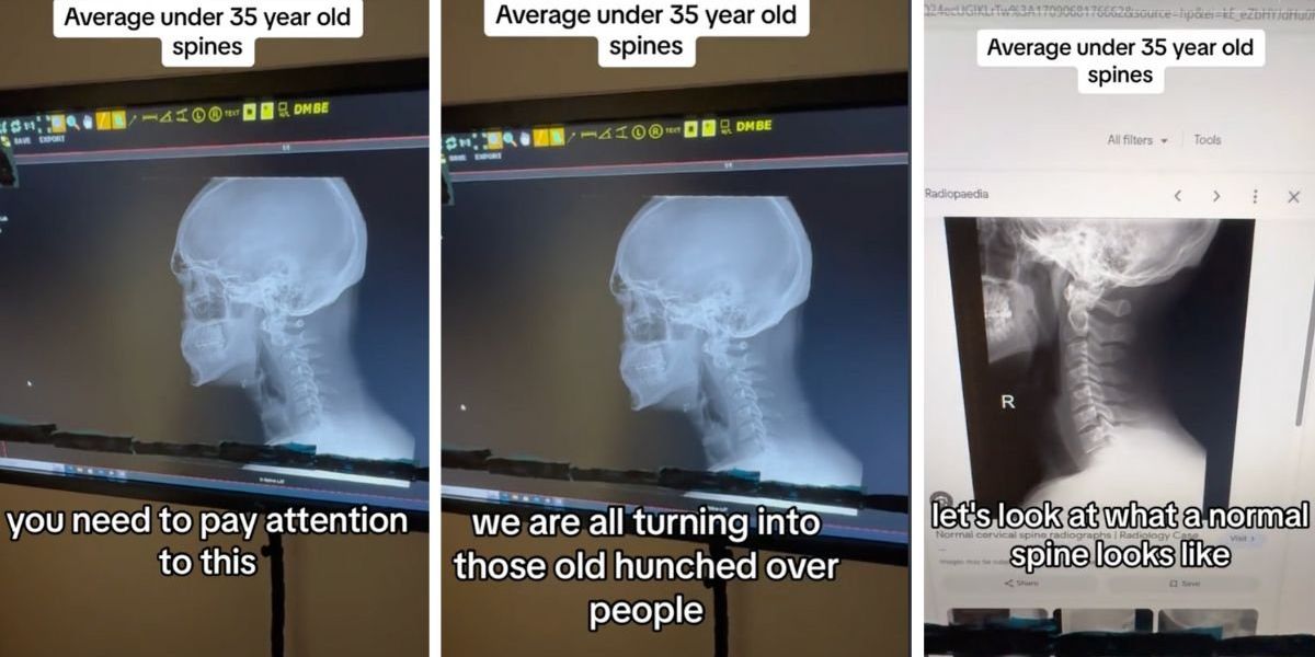 Chiropractor shows how folks under 35 are turning into 'old, hunched-backed people'
