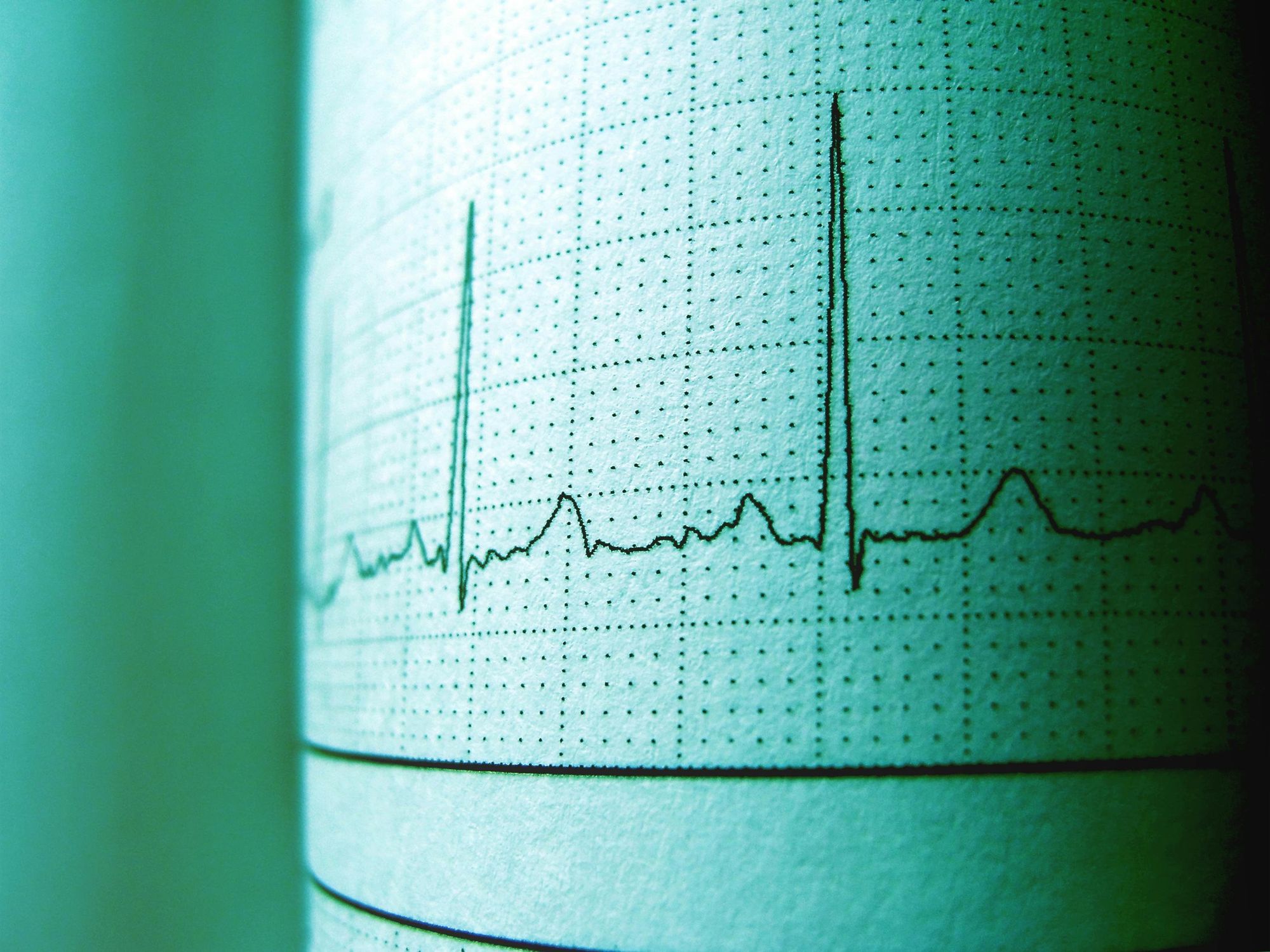 electrocardiogram graph displaying cardiac activity