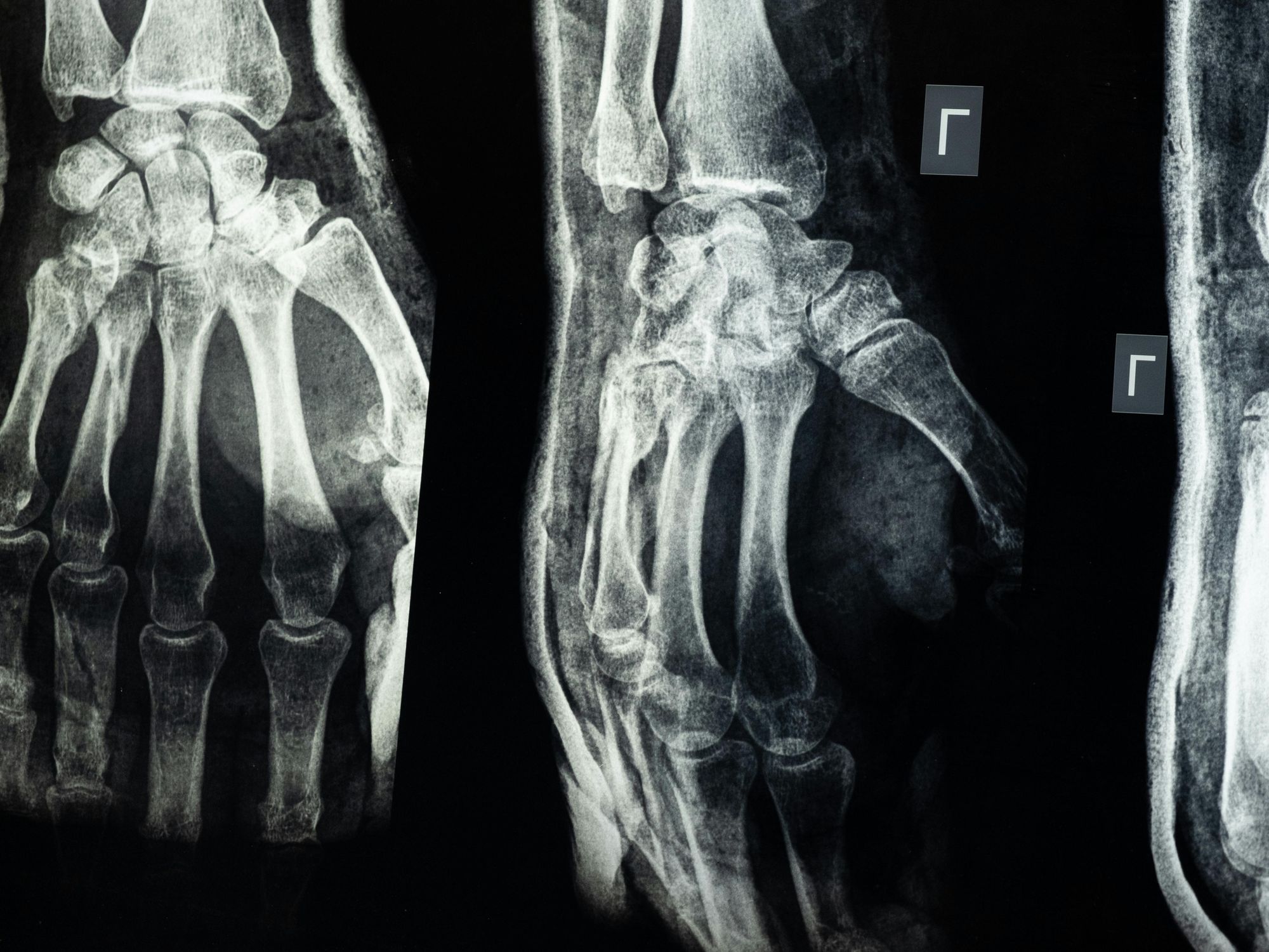 X-ray image showing the skeletal structure of a hand