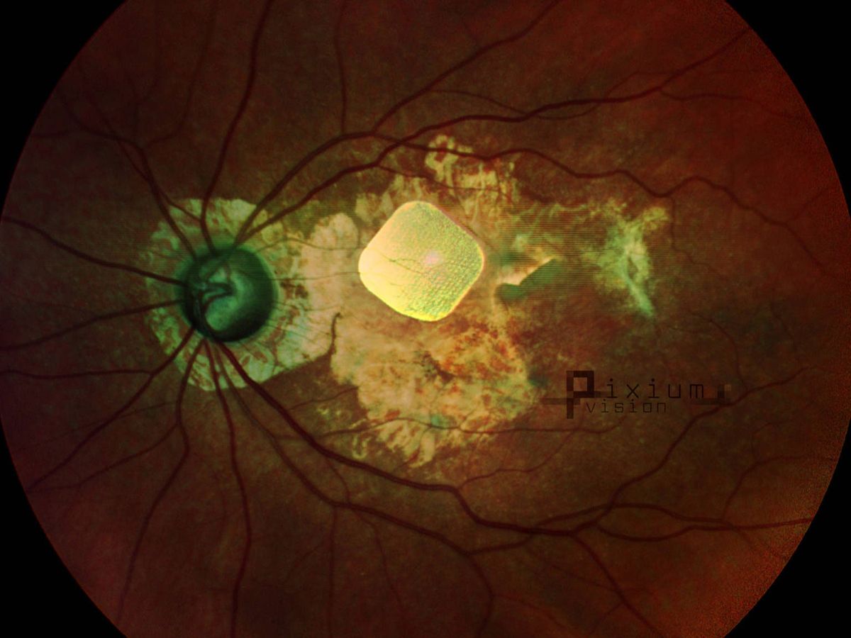 Bionic Eye Gets a New Lease of Life