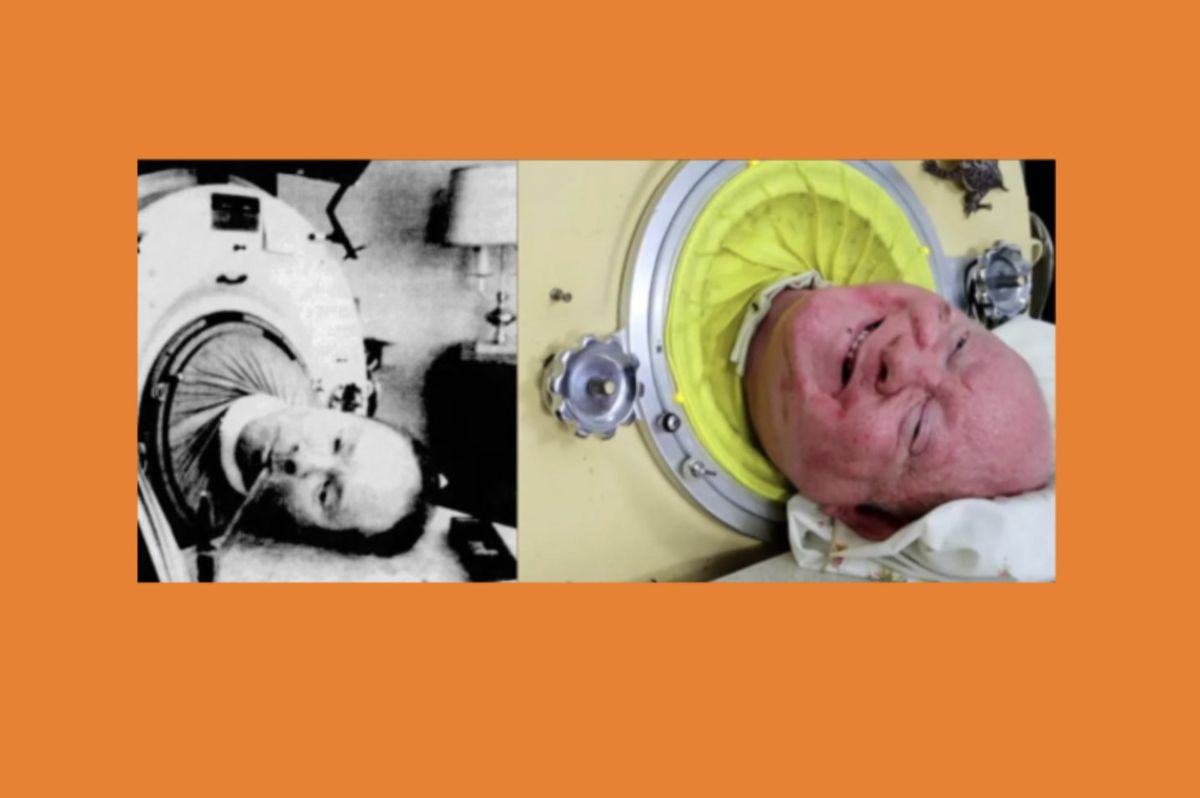 Images of a younger and older Paul Alexander in his iron lung