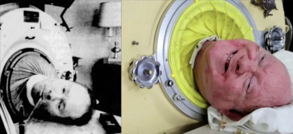 Images of a younger and older Paul Alexander in his iron lung