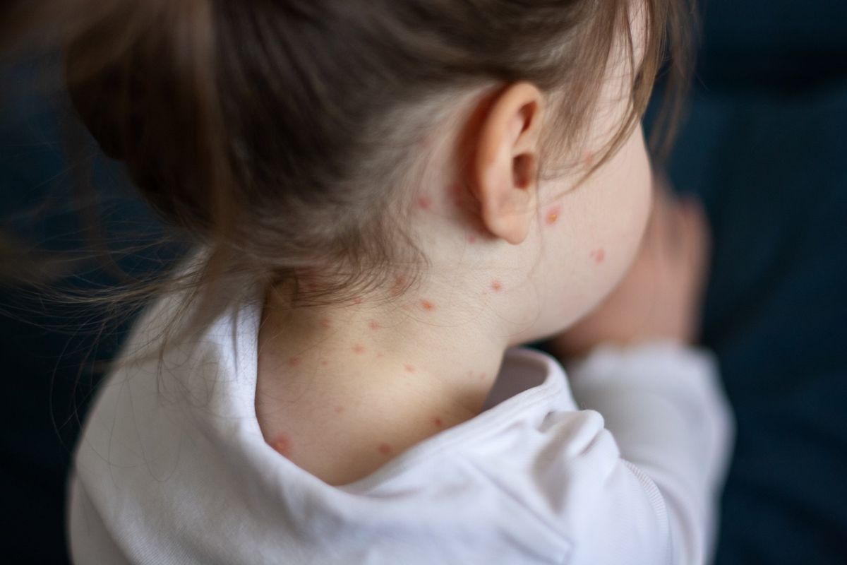 Non solo punture: contro il morbillo l’alimentazione è fondamentale