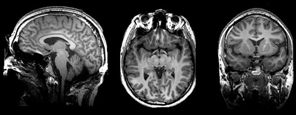 A black and white brain scan from multiple angles