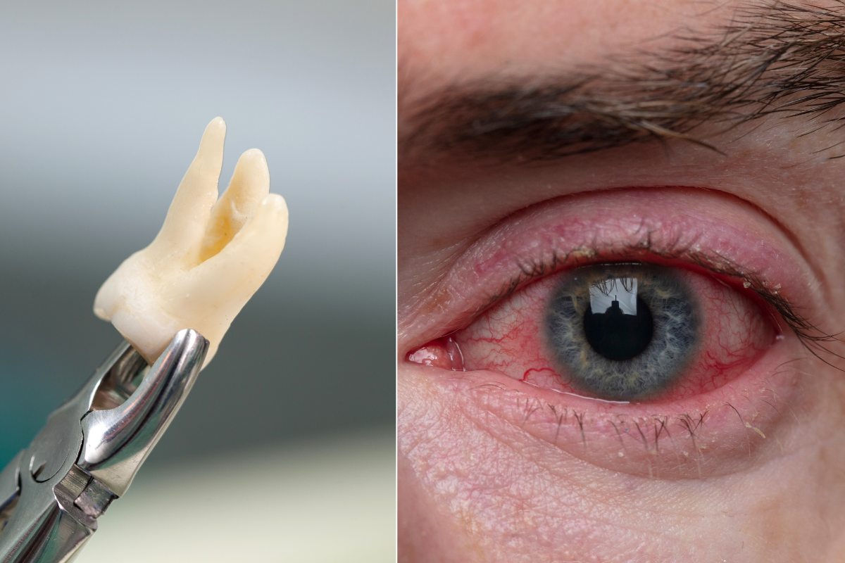 a tooth held in between pliers; close up of an irritated eye