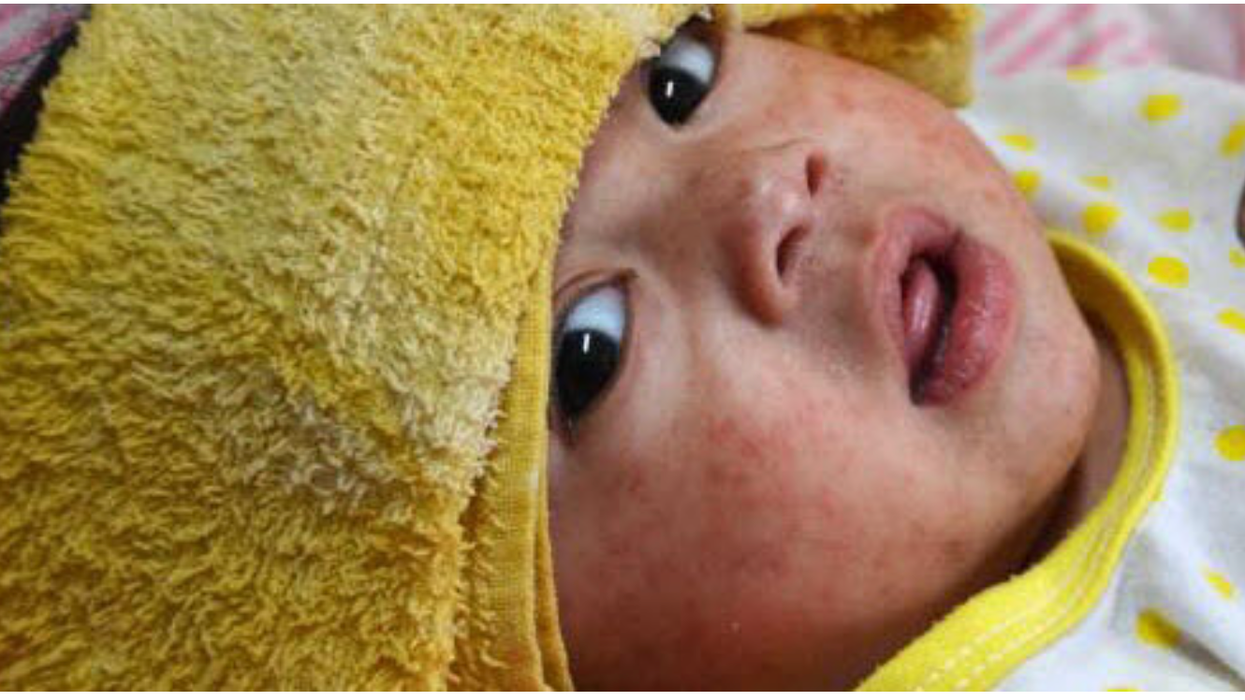 Amid Spreading Measles Outbreak, Kennedy Renews His Anti-Vax Obsession