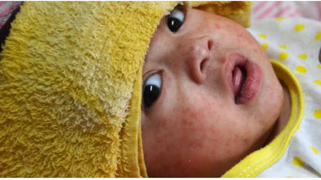 Amid Spreading Measles Outbreak, Kennedy Renews His Anti-Vax Obsession