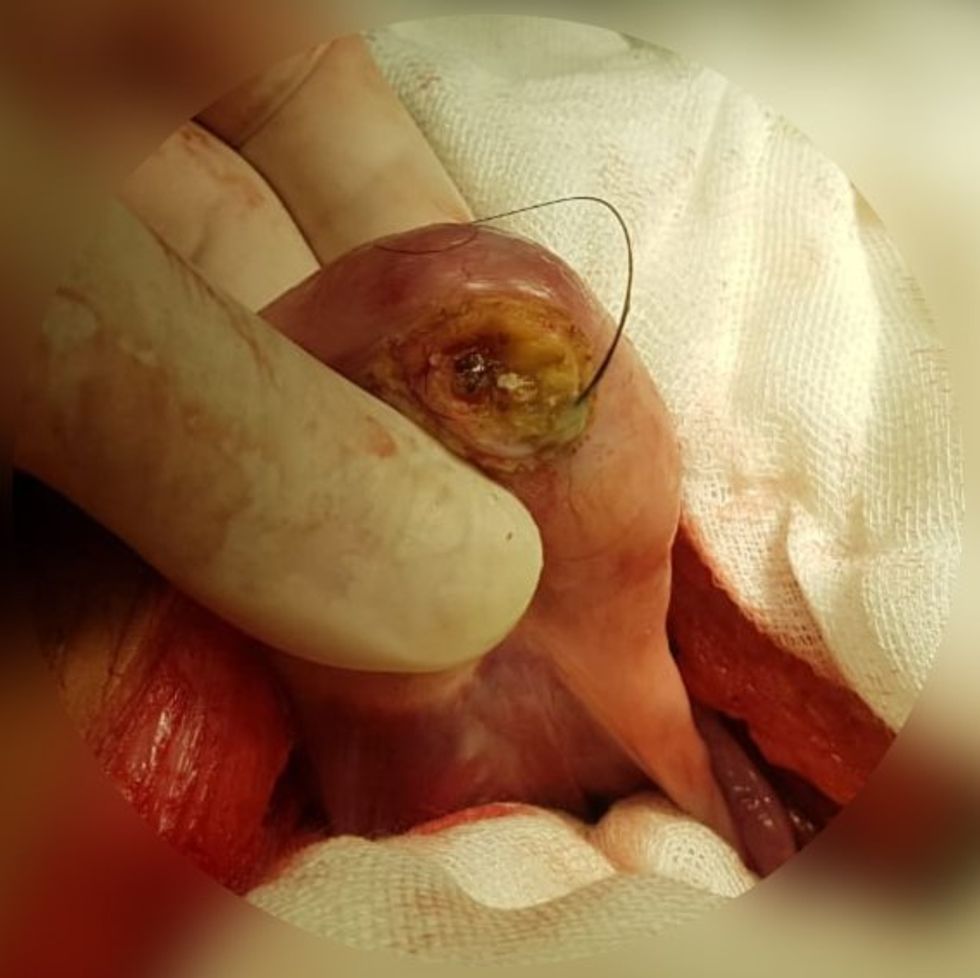 teratoma, tumor, cancer, women's health, women, health, hospital, doctor, OBGYN, reproductive health, ovarian cyst