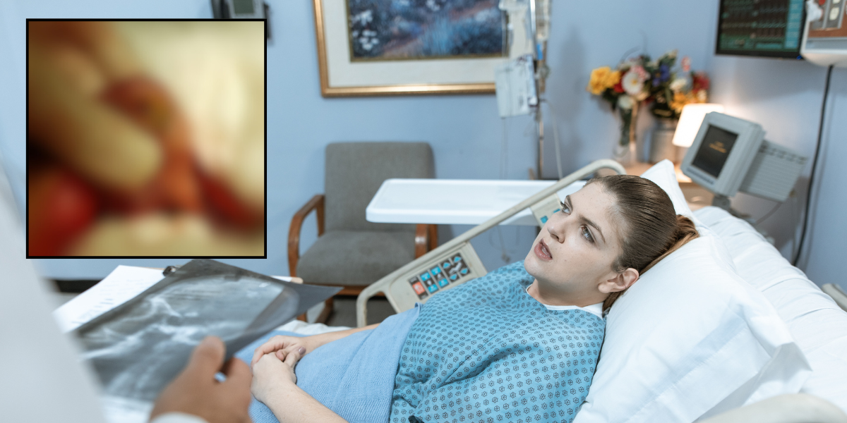 Woman has cyst removed and is stunned to learn it had teeth, hair, and maybe even an eyeball